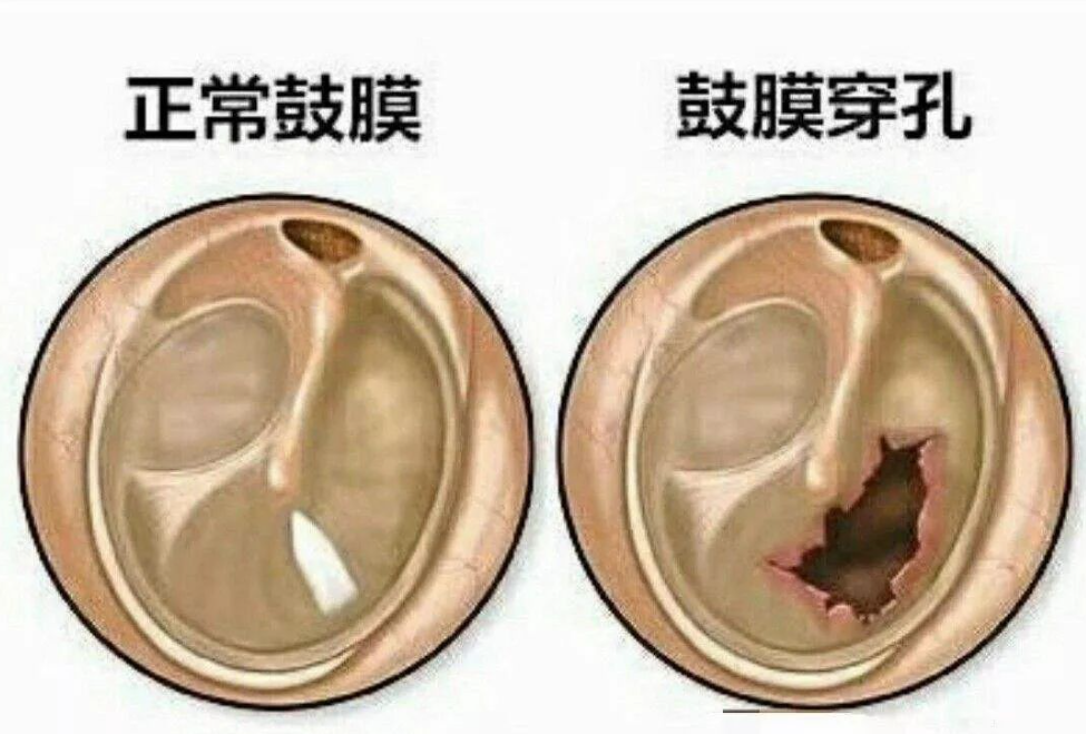 鼓膜穿孔还能听声吗？